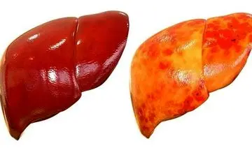 آشنایی با بهترین روشهای طب سنتی برای درمان "کبد چرب" 