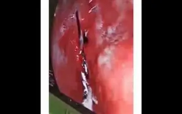 خارج کردن سوزنی بزرگ از معده زنی در یزد/ او ۲۱ روز سوزن را در شکمش تحمل کرد