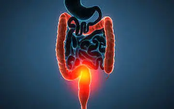 کولیت اولسراتیو؛ وقتی التهاب روده آرام نمی‌گیرد