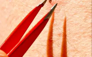 چگونه از شر موهای زیر پوستی راحت شویم؟

