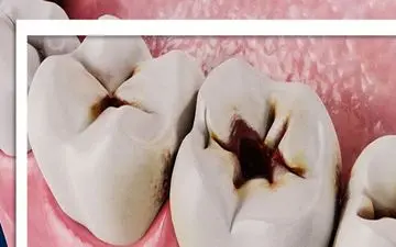 شایع‌ترین علت پوسیدگی دندان چیست؟