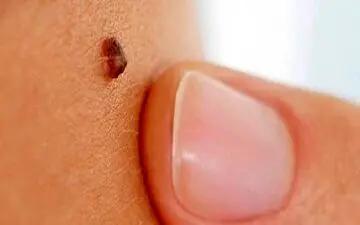 خال سرطانی چطور قابل شناسایی است؟