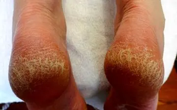 دلایل ایجاد ترک پاشنه‌ی پا