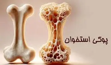 وقتی استخوان‌ها پوک می‌شوند