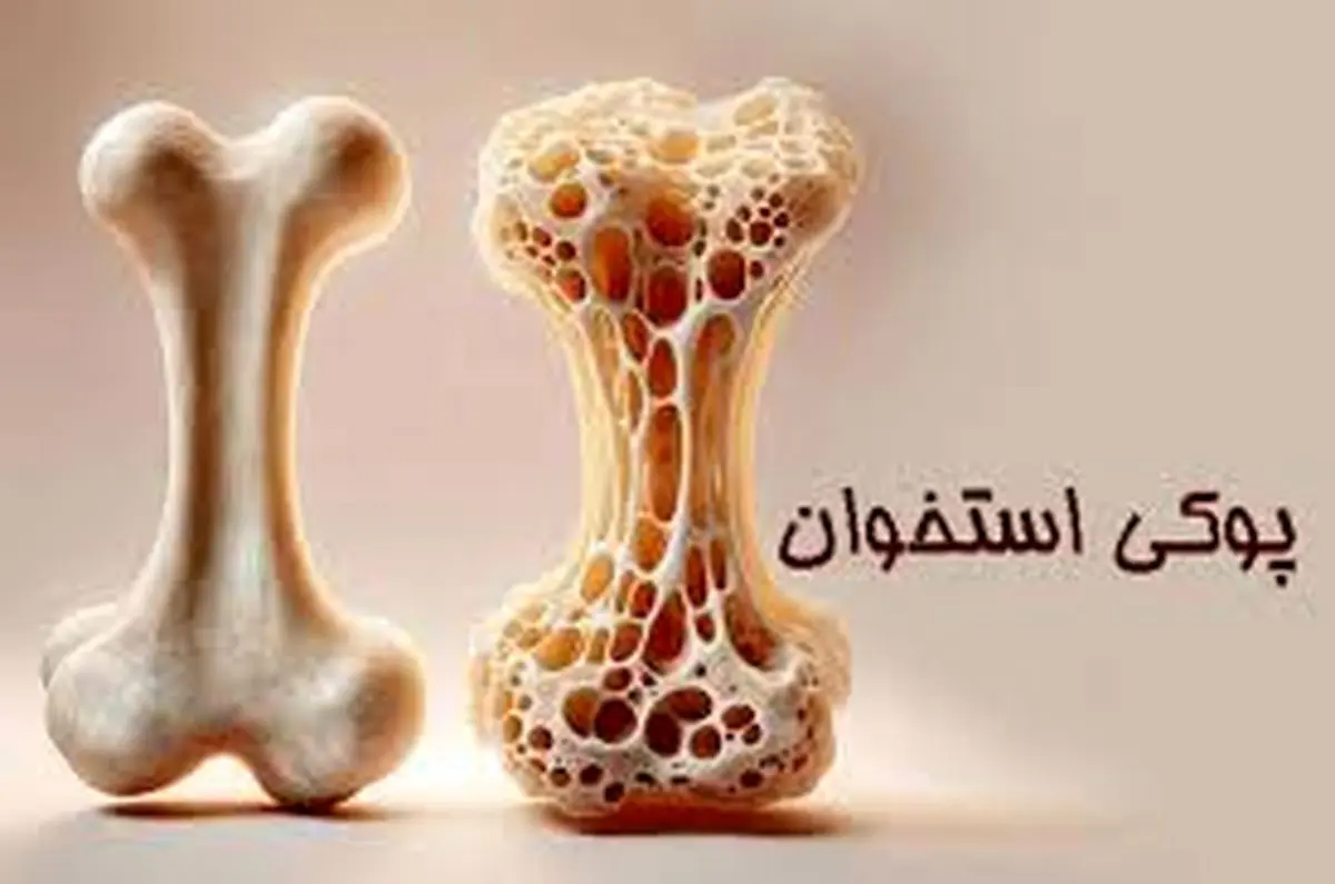 وقتی استخوانها پوک میشوند