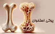 وقتی استخوان‌ها پوک می‌شوند