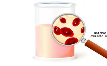 تشخیص ادرار خونی