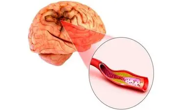 سکته مغزی خفیف را ساده نگیرید