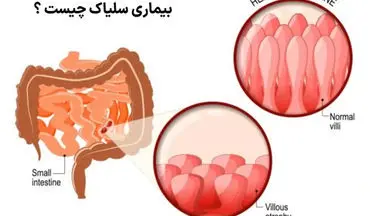 همه چیز درباره بیماری سلیاک؛ از علت تا درمان!