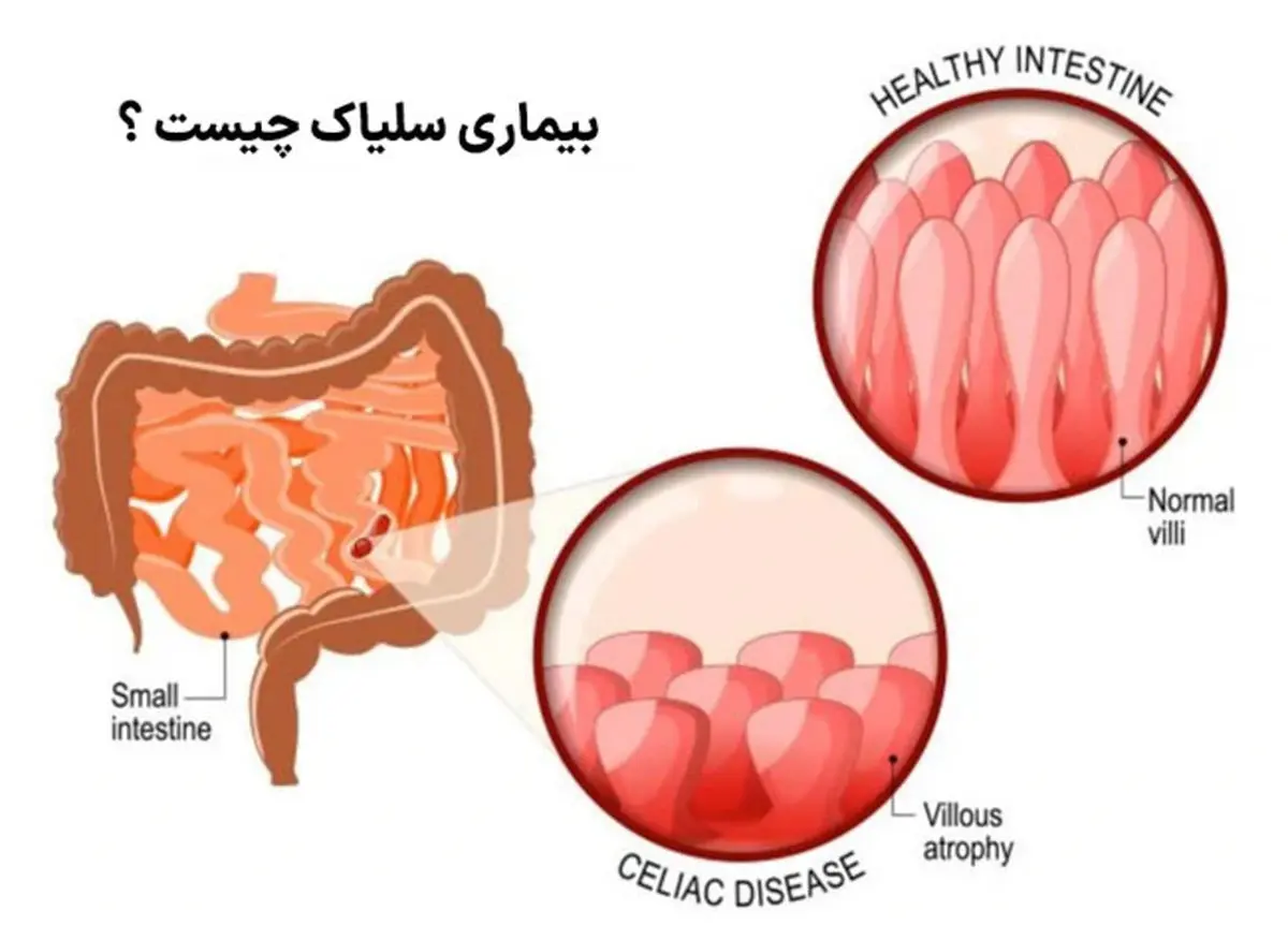 همه چیز درباره بیماری سلیاک؛ از علت تا درمان!