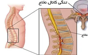 علائم تنگی کانال نخاعی چیست؟