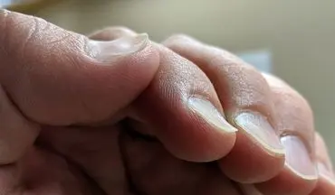 از روی ناخن و کف دست پی به کم خونی ببرید!
