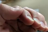 از روی ناخن و کف دست پی به کم خونی ببرید!
