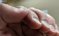 از روی ناخن و کف دست پی به کم خونی ببرید!