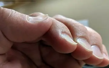 از روی ناخن و کف دست پی به کم خونی ببرید!