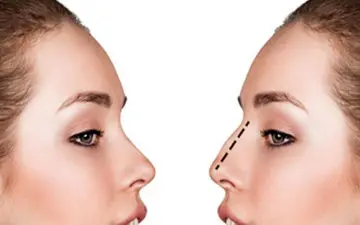 علت برآمدگی استخوان بینی بعد از عمل