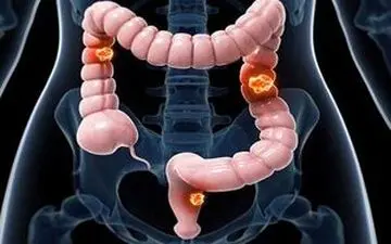 خون در مدفوع را شوخی نگیرید؛ این سرطان قابل پیشگیری است؛ اما هنوز قربانی می‌گیرد