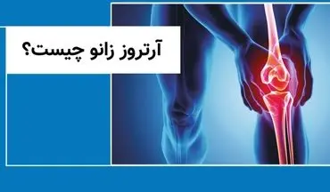 آمار ۱۵ درصدی آرتروز در ایرانیان / تعویض مفصل؛ درمان نهایی این بیماری