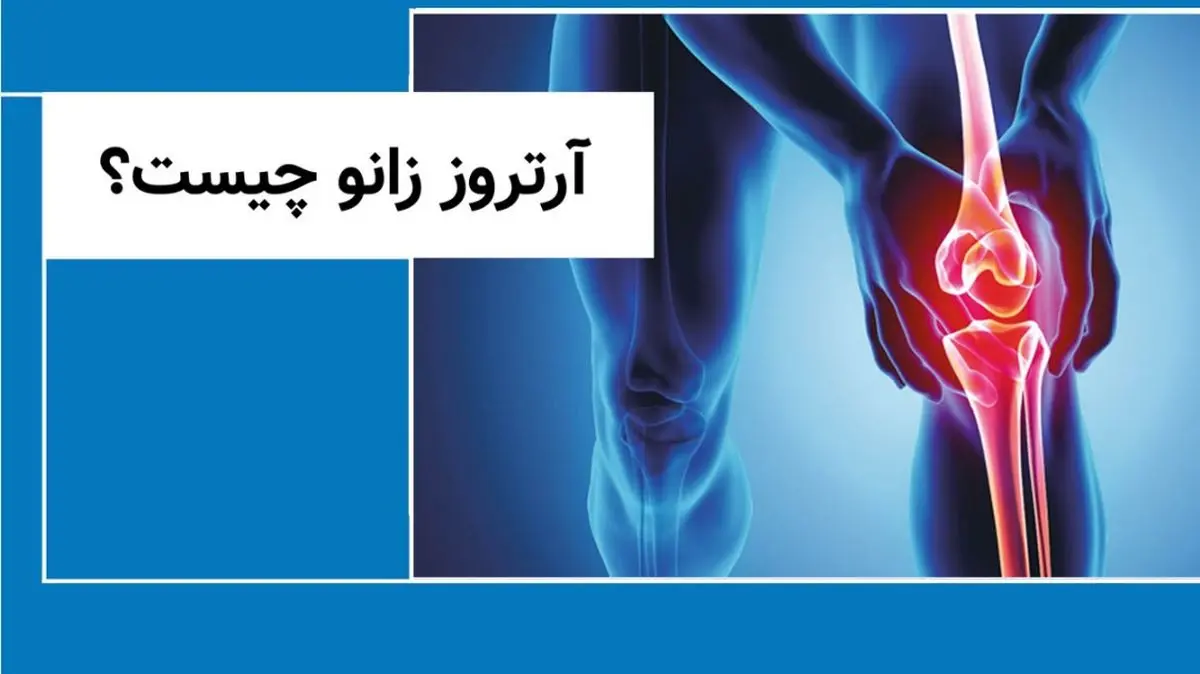 آمار ۱۵ درصدی آرتروز در ایرانیان / تعویض مفصل؛ درمان نهایی این بیماری