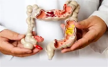 رژیم غذایی پرچرب و آنتی‌‌بیوتیک، عوامل مهم بروز بیماری‌‌های التهابی روده