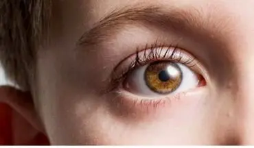 خشکی چشم درمانی دارد؟