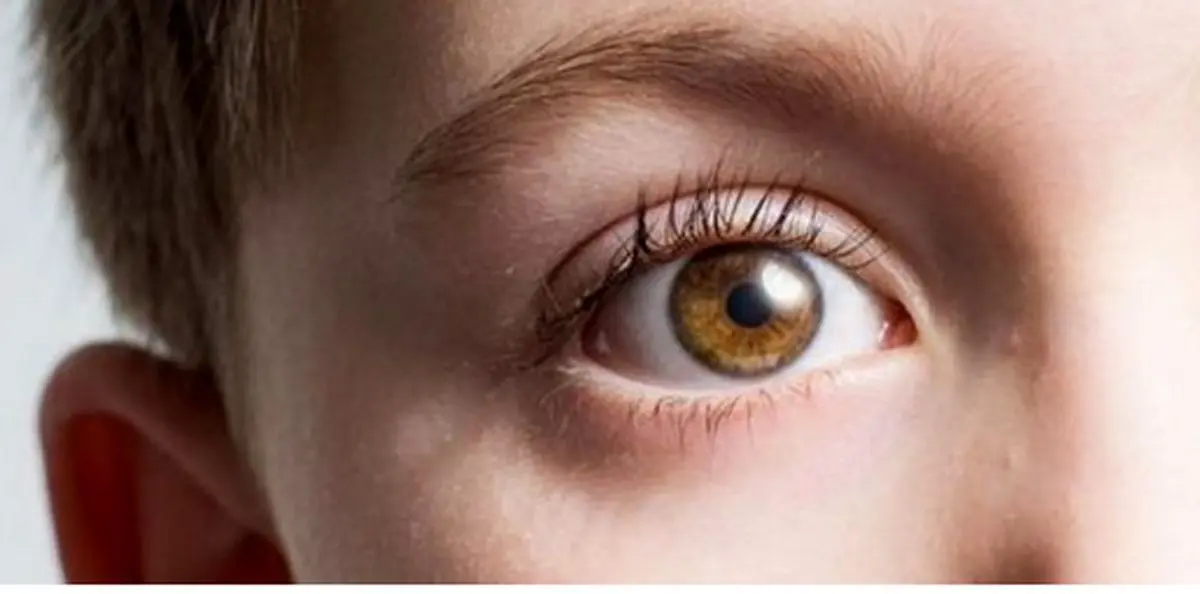 خشکی چشم درمانی دارد؟