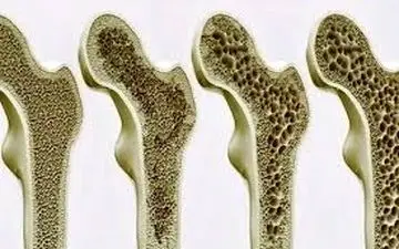 30 درصد زنان مبتلا به این بیماری مبتلا هستند 