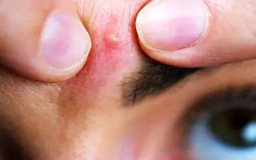 عوارض ناشی از کورک پوست چیست؟