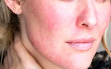 روش‌های طلایی برای کاهش قرمزی پوست پس از اپیلاسیون