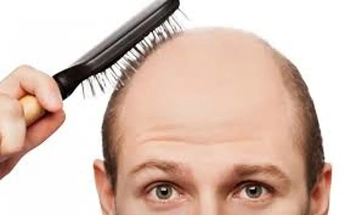 اصلی ترین علل ریزش مو و راه درمان آن 