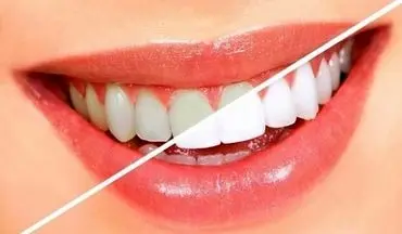  چگونه با طب سنتی دندانهایمان را سفید کنیم؟!
