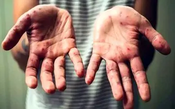 آبله میمونی قابلیت تبدیل شدن به «پاندمی» را دارد؟