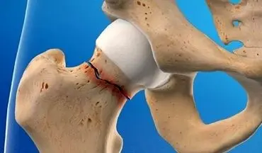 پیشگیری از شکستگی های مکرر با درمان به موقع پوکی استخوان