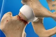 پیشگیری از شکستگی های مکرر با درمان به موقع پوکی استخوان