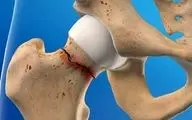 پیشگیری از شکستگی های مکرر با درمان به موقع پوکی استخوان