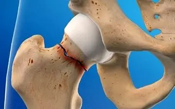 پیشگیری از شکستگی های مکرر با درمان به موقع پوکی استخوان