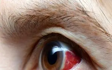 سکته چشمی چیست؟ چگونه مانع از سکته چشمی بشویم؟