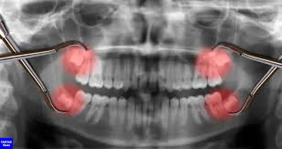 کارهایی که باید بعد از کشیدن دندان عقل باید انجام داد