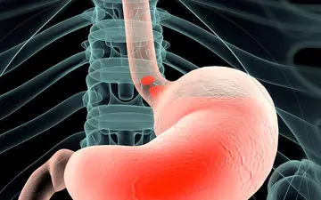 عمل اسلیو بهتر است یا بای پس؟ + مقایسه
