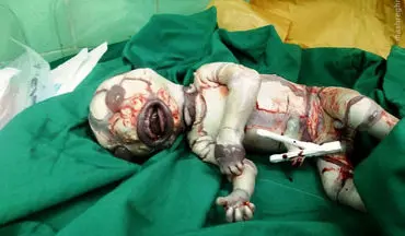  تولد نوزادی در ایران با ظاهری عجیب+عکس