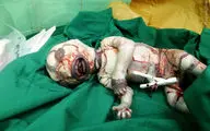  تولد نوزادی در ایران با ظاهری عجیب+عکس