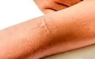 چگونه جای زخم‌های کهنه پوست را درمان کنیم؟