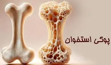 پوکی استخوان؛ تشخیص و درمان به‌ موقع