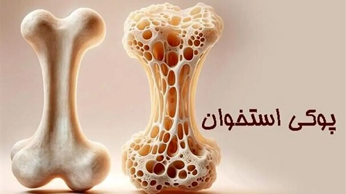 پوکی استخوان؛ تشخیص و درمان به موقع