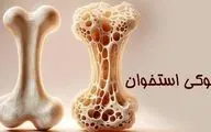 پوکی استخوان؛ تشخیص و درمان به‌ موقع