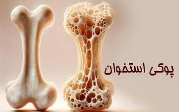 پوکی استخوان؛ تشخیص و درمان به‌ موقع