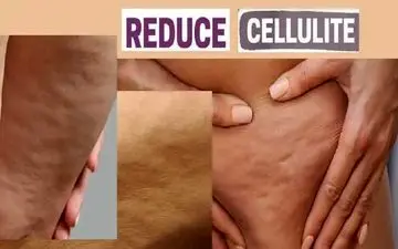 راهکار مؤثر خانگی برای کاهش سلولیت و سفت‌کردن پوست