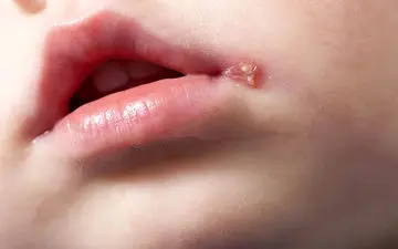 بهترین پماد تبخال؛ درمان فوری و آسان با توصیه‌های کاربردی