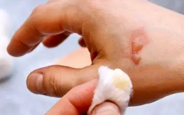 اگر بدنم سوخت چکار کنم؟ | 4 راه برای بهبود زخم پس از سوختگی

