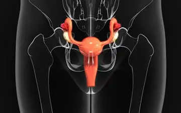 فریز کردن رحم چیست؟